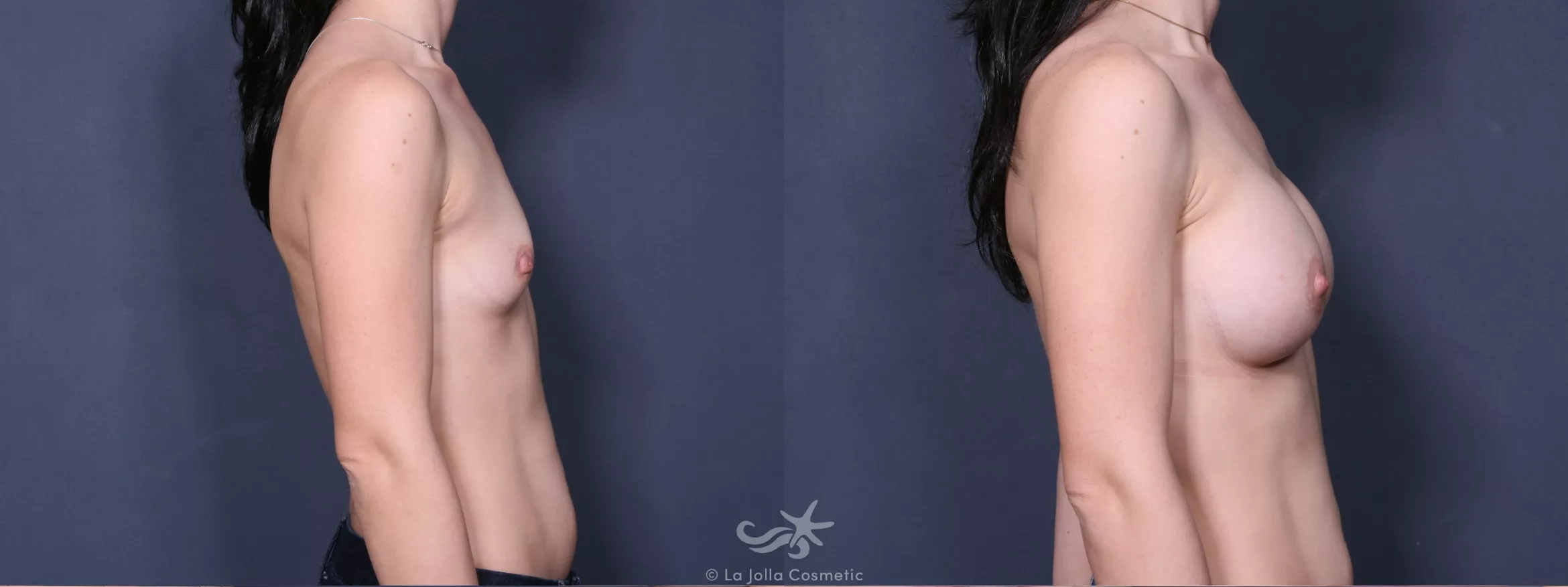 Before & After Breast Augmentation Result 341 Right Side View in San Diego, CA
