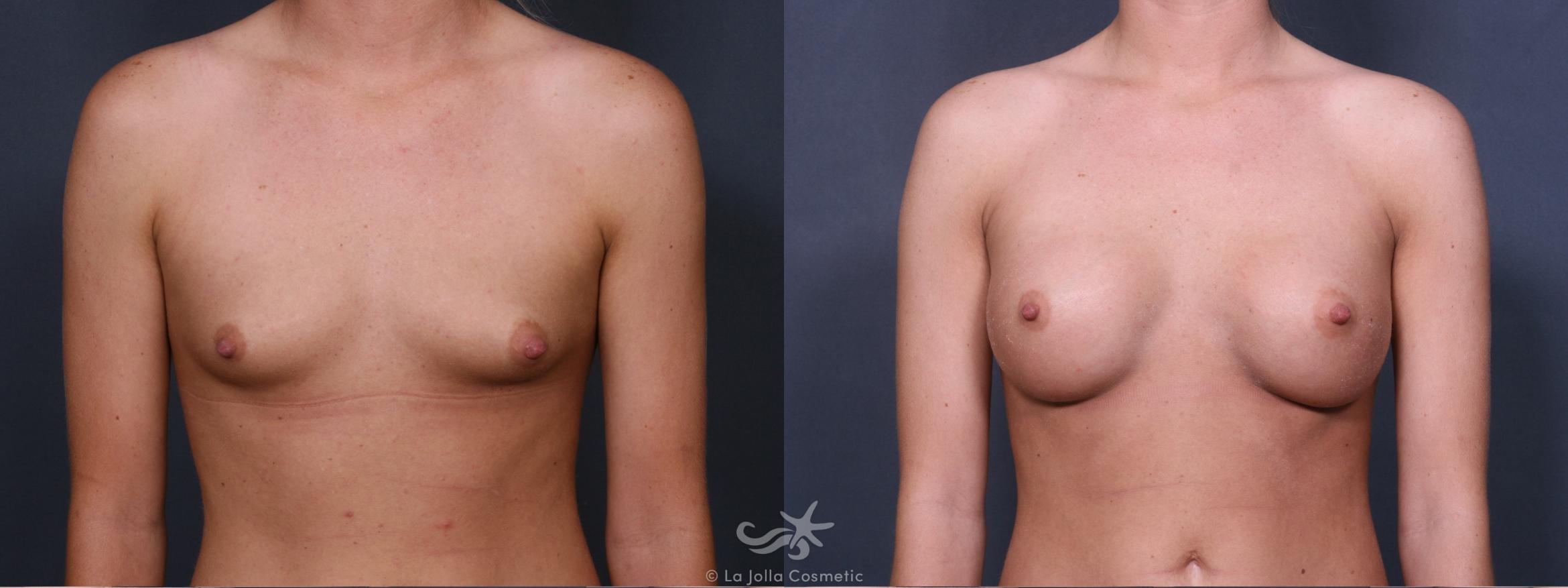Before & After Breast Augmentation Result 342 Front View in San Diego, CA