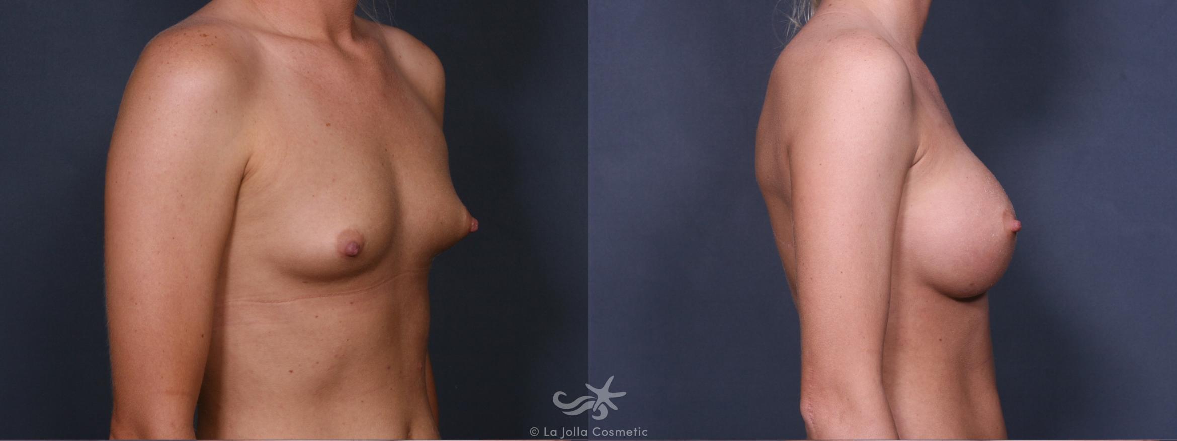 Before & After Breast Augmentation Result 342 Right Oblique View in San Diego, CA