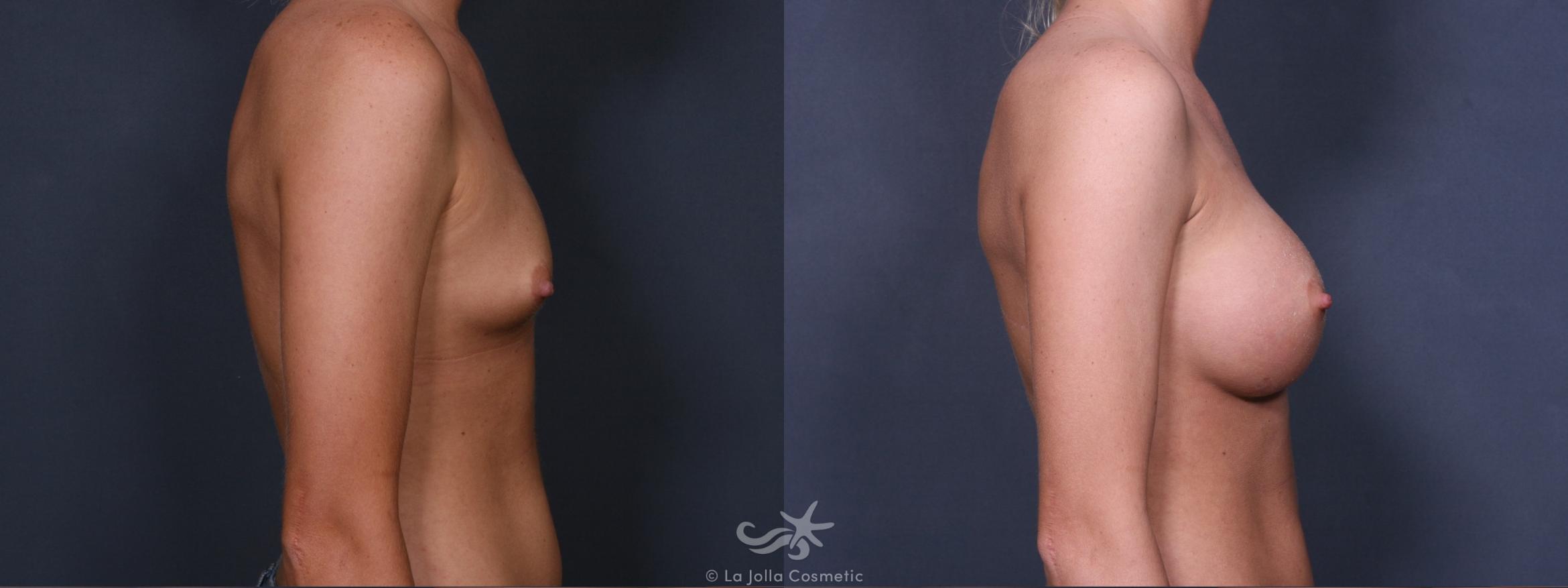 Before & After Breast Augmentation Result 342 Right Side View in San Diego, CA