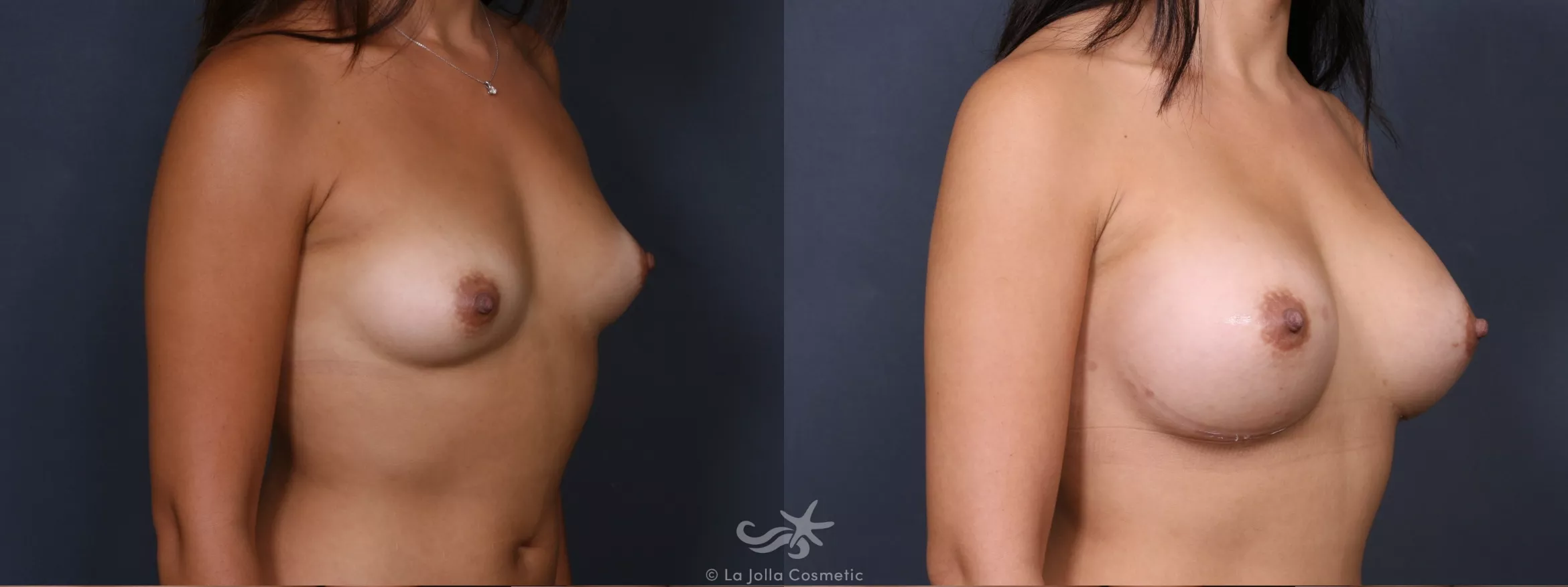 Before & After Breast Augmentation Result 344 Right Oblique View in San Diego, CA