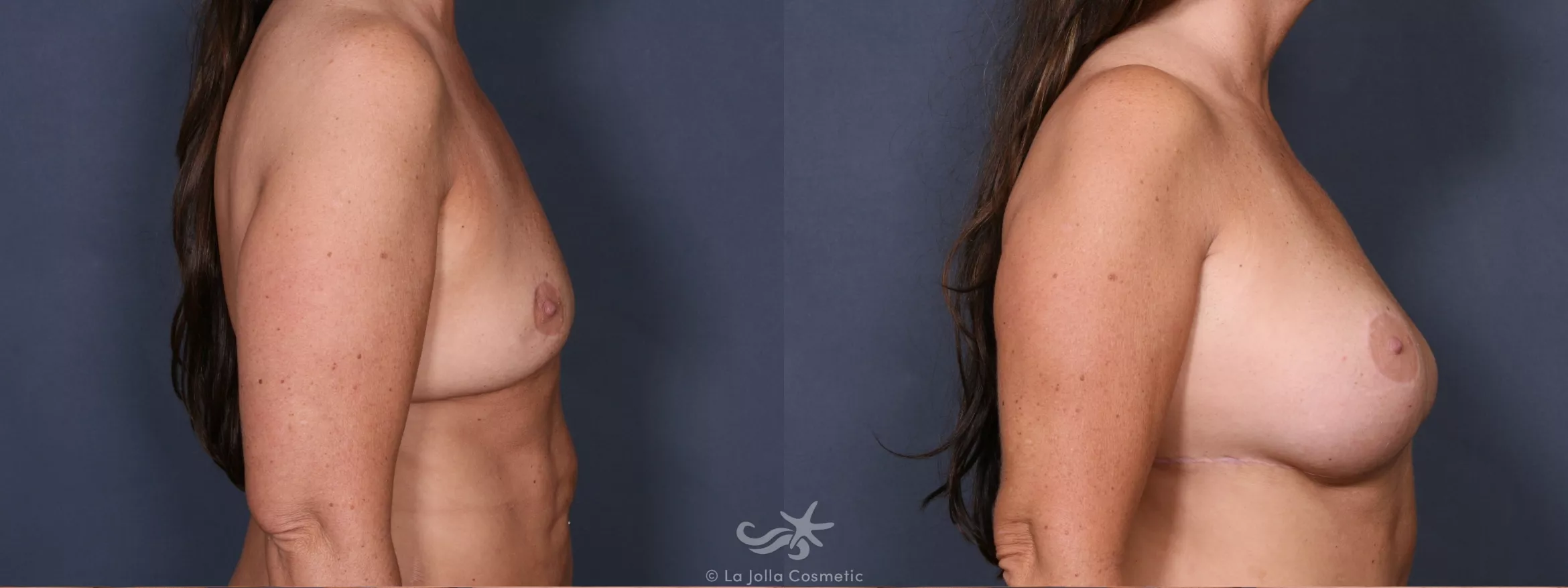 Before & After Breast Augmentation Result 345 Right Side View in San Diego, CA
