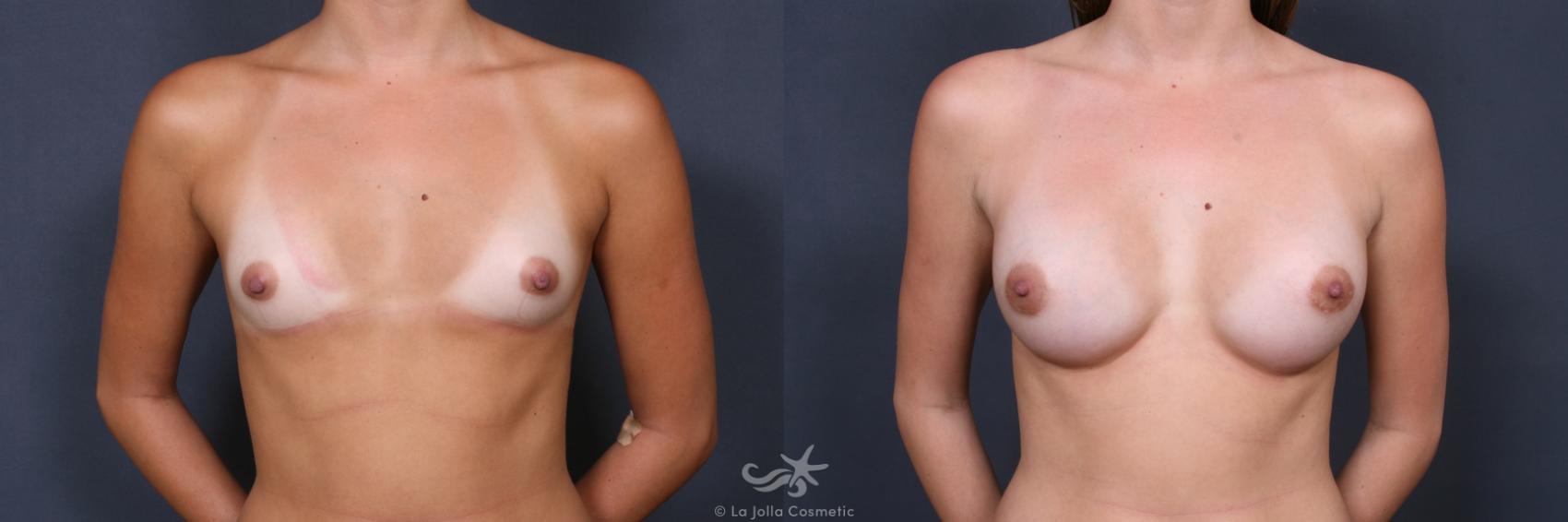 Before & After Breast Augmentation Result 349 Front View in San Diego, CA