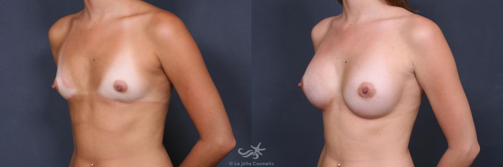 Before & After Breast Augmentation Result 349 Left Oblique View in San Diego, CA