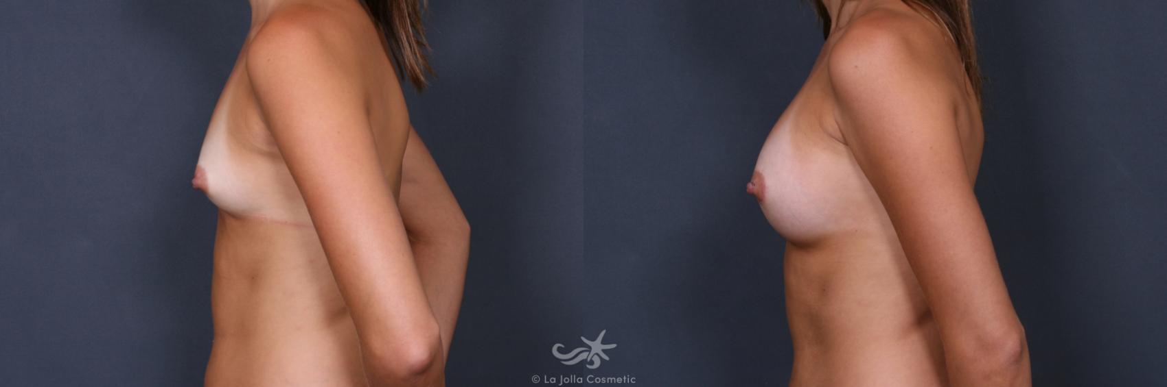 Before & After Breast Augmentation Result 349 Left Side View in San Diego, CA