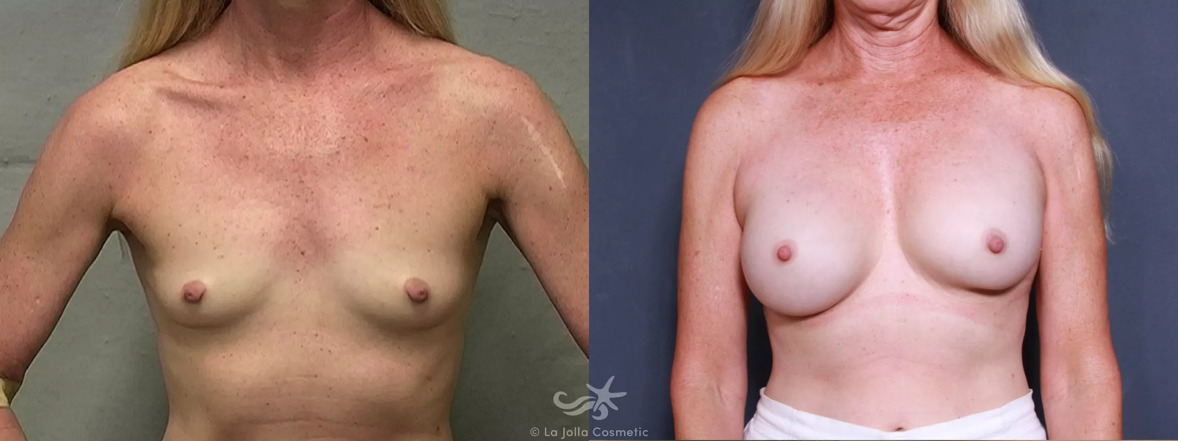 Before & After Breast Augmentation Result 350 Front View in San Diego, CA