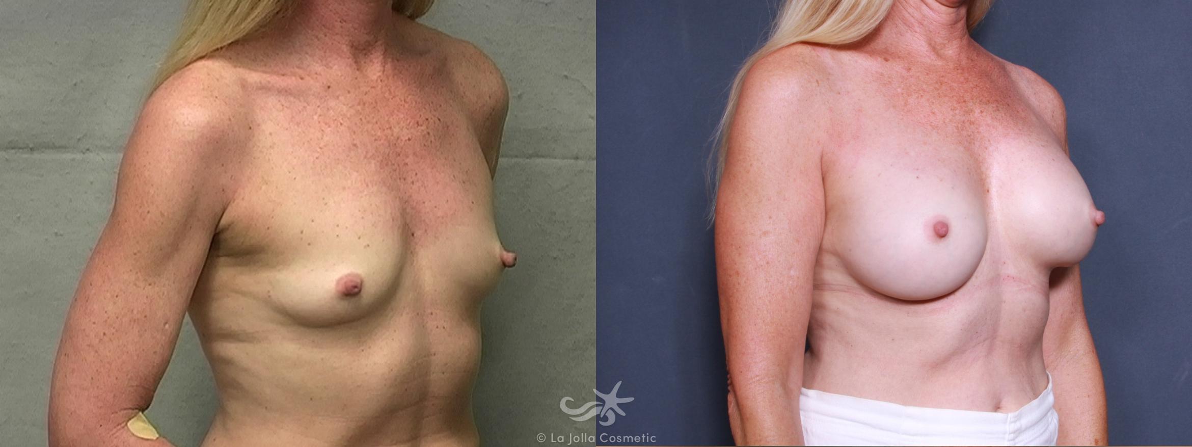 Before & After Breast Augmentation Result 350 Right Oblique View in San Diego, CA