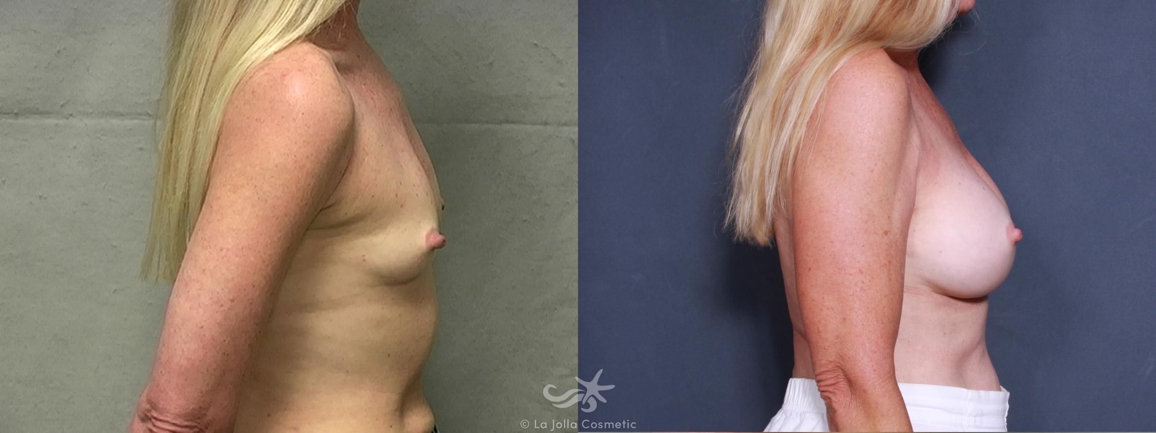 Before & After Breast Augmentation Result 350 Right Side View in San Diego, CA
