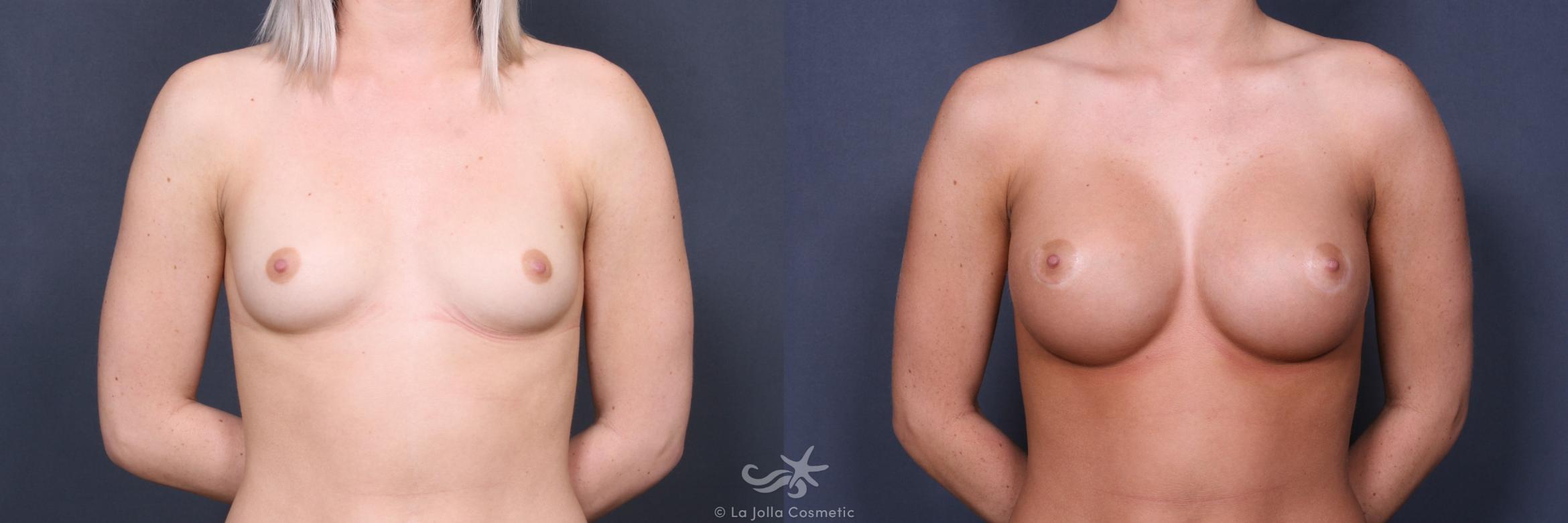 Before & After Breast Augmentation Result 352 Front View in San Diego, CA