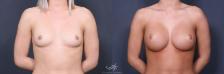 Before & After Breast Augmentation Result 352 Front View in San Diego, Carlsbad, CA