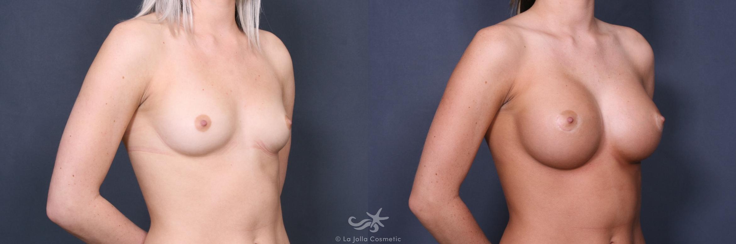 Before & After Breast Augmentation Result 352 Right Oblique View in San Diego, CA