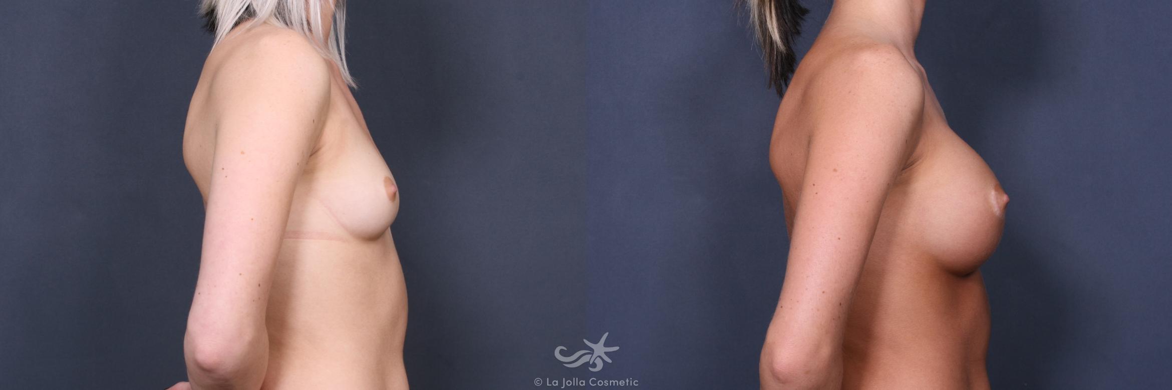 Before & After Breast Augmentation Result 352 Right Side View in San Diego, CA