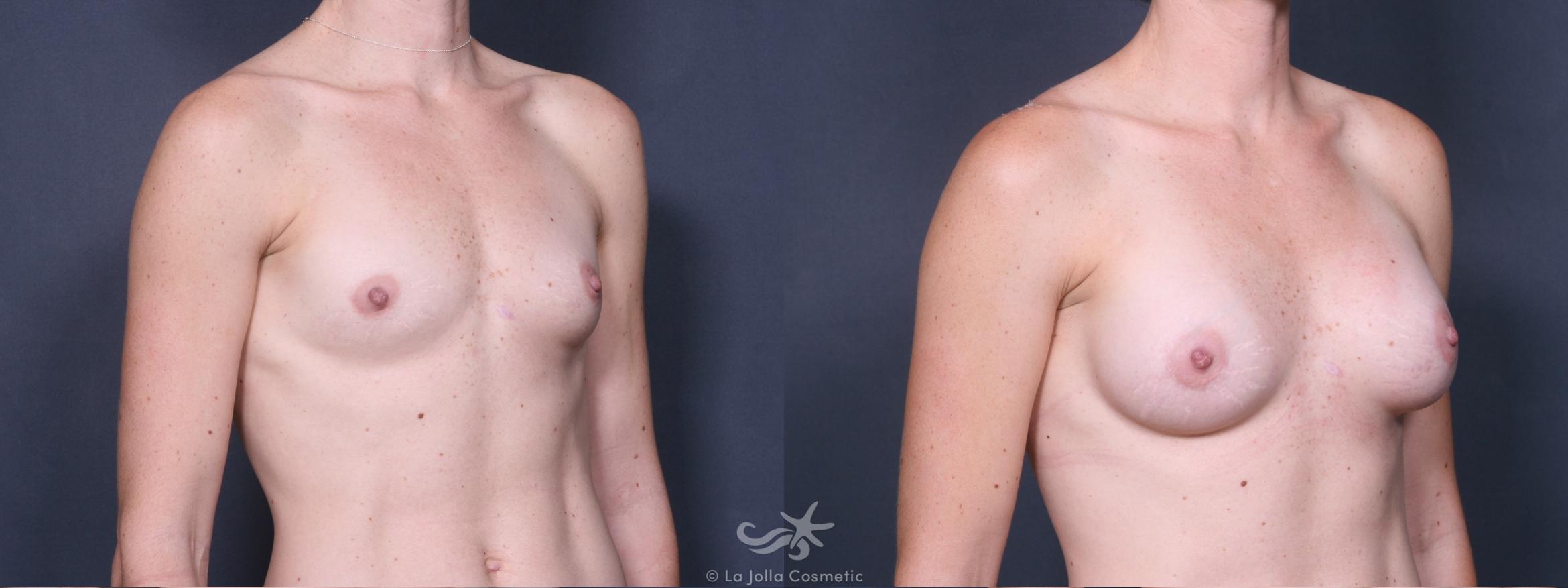 Before & After Breast Augmentation Result 354 Right Oblique View in San Diego, CA