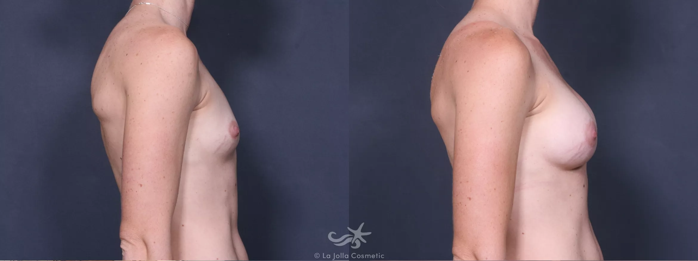 Before & After Breast Augmentation Result 354 Right Side View in San Diego, CA