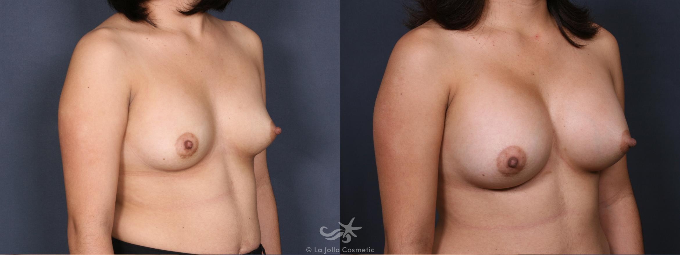 Before & After Breast Augmentation Result 355 Right Oblique View in San Diego, CA