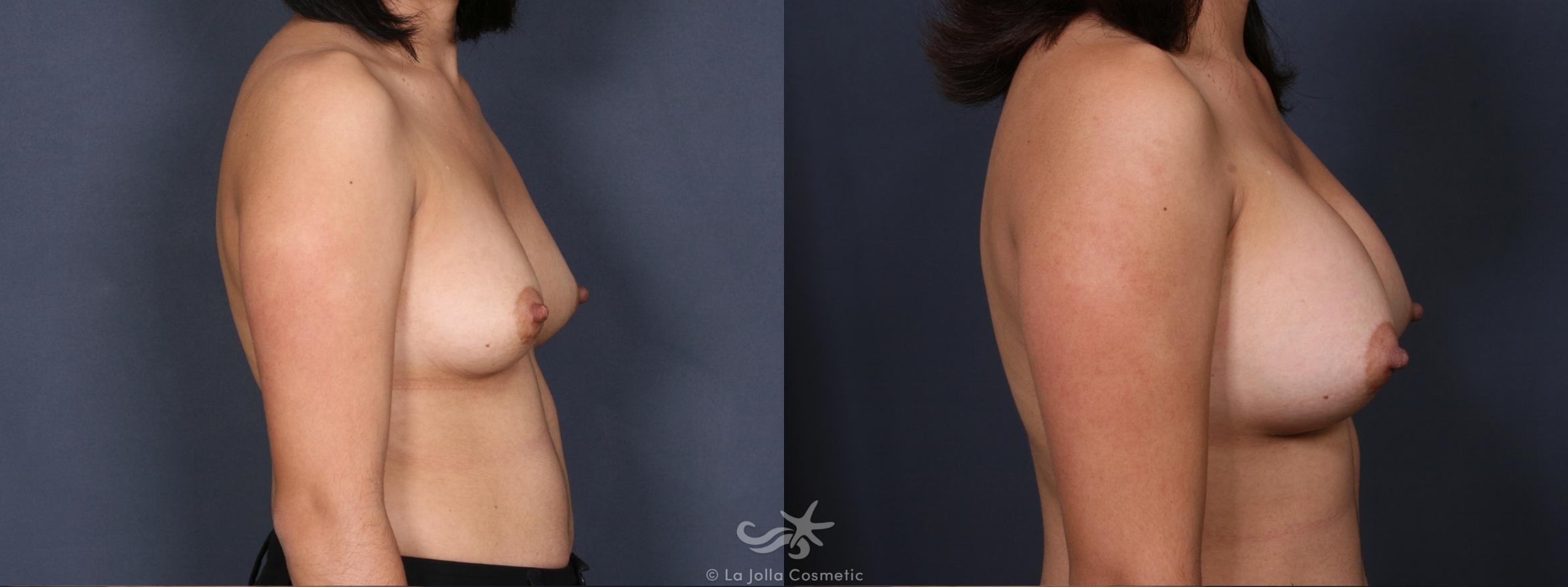 Before & After Breast Augmentation Result 355 Right Side View in San Diego, CA