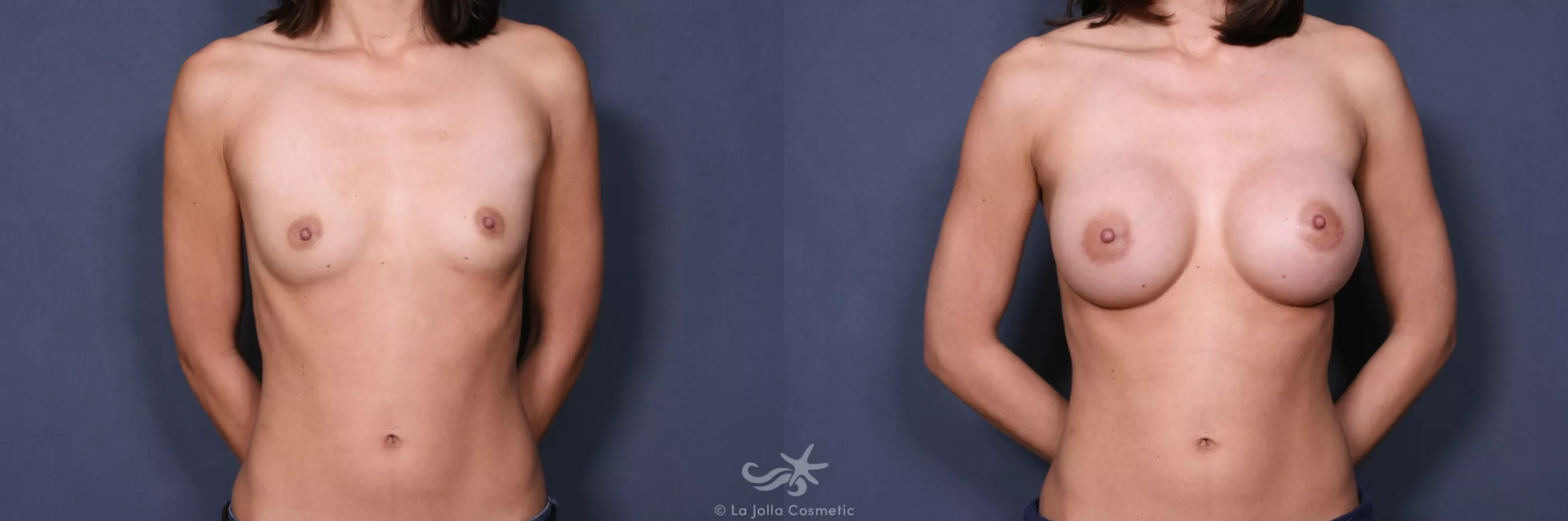 Before & After Breast Augmentation Result 358 Front View in San Diego, CA