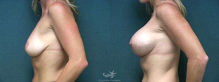 Before & After Breast Augmentation Result 361 Left Side View in San Diego, Carlsbad, CA