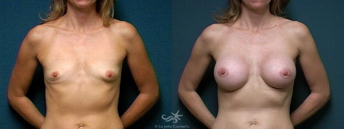 Before & After Breast Augmentation Result 364 Front View in San Diego, Carlsbad, CA