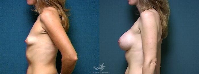 Before & After Breast Augmentation Result 364 Left Side View in San Diego, Carlsbad, CA