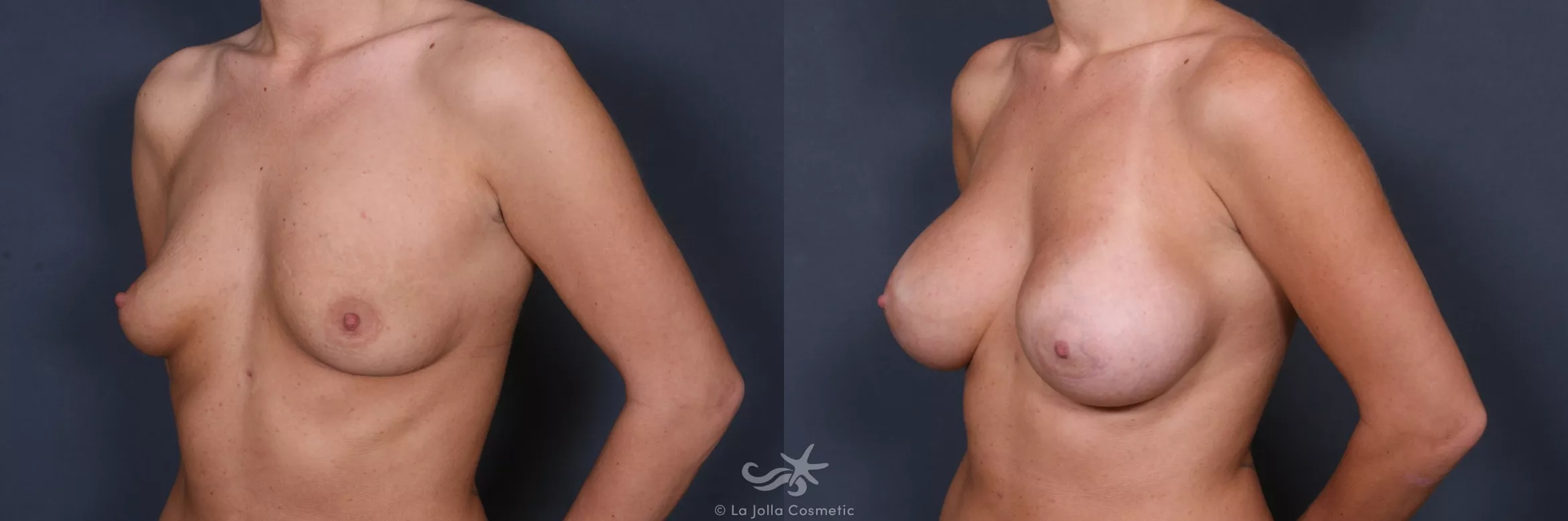 Before & After Breast Augmentation Result 367 Left Oblique View in San Diego, CA