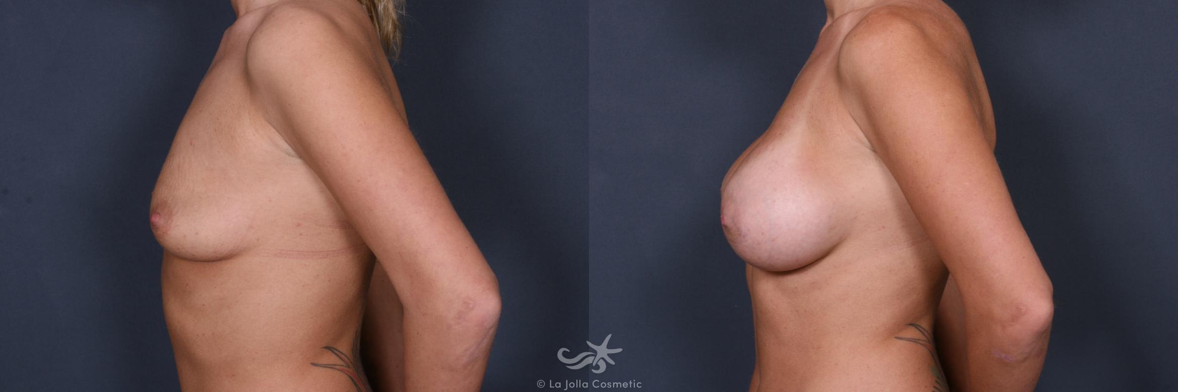 Before & After Breast Augmentation Result 367 Left Side View in San Diego, CA