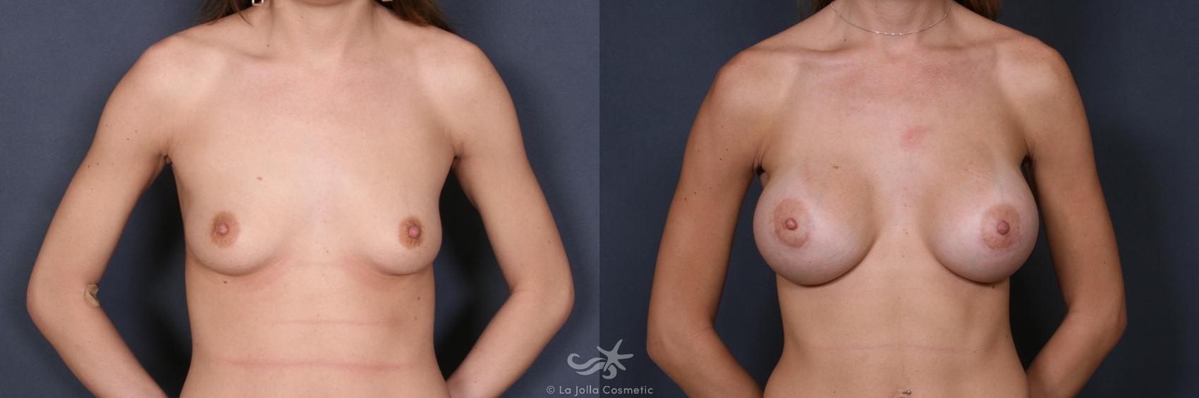Before & After Breast Augmentation Result 374 Front View in San Diego, CA