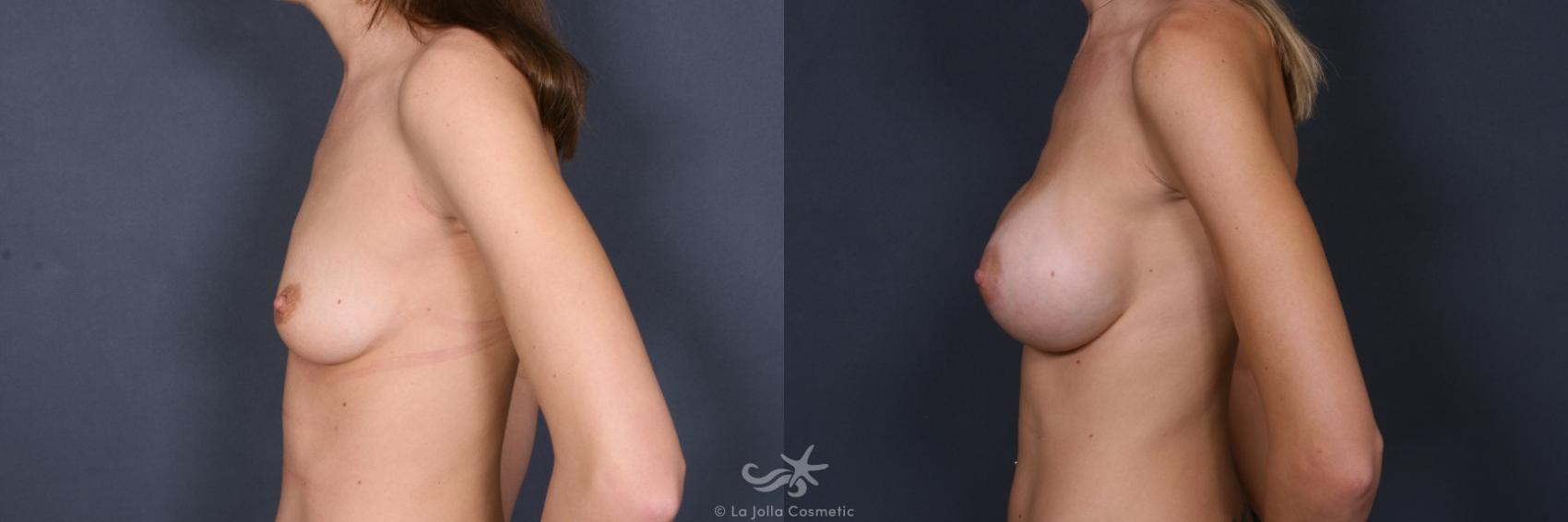 Before & After Breast Augmentation Result 374 Left Side View in San Diego, CA