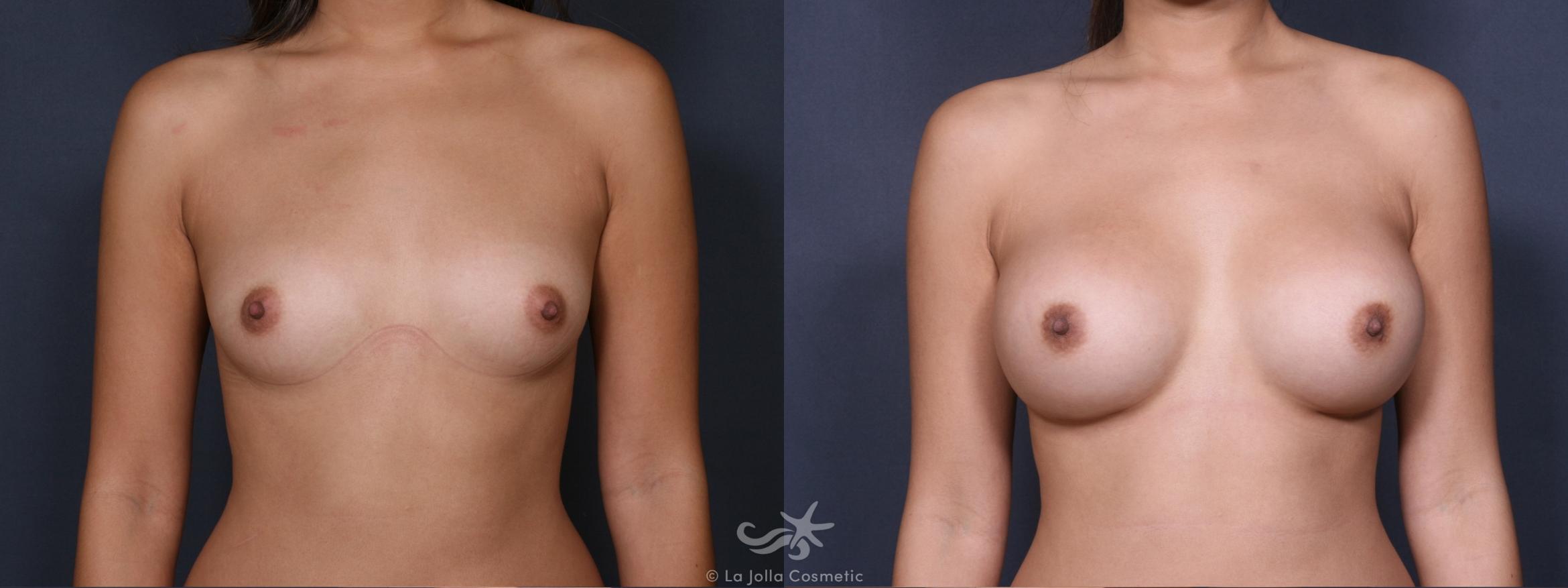 Before & After Breast Augmentation Result 375 Front View in San Diego, CA