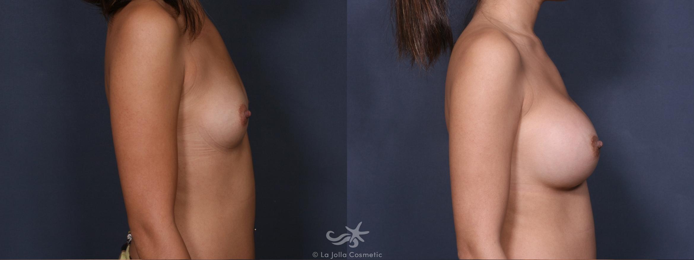 Before & After Breast Augmentation Result 375 Right Side View in San Diego, CA