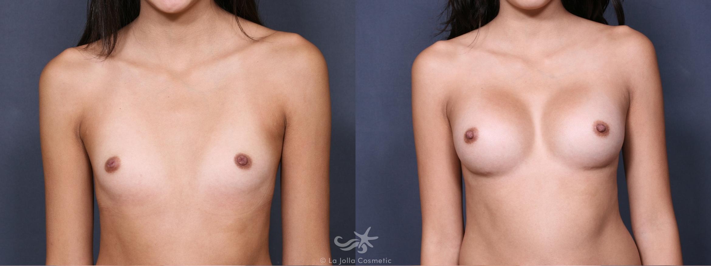 Before & After Breast Augmentation Result 379 Front View in San Diego, CA