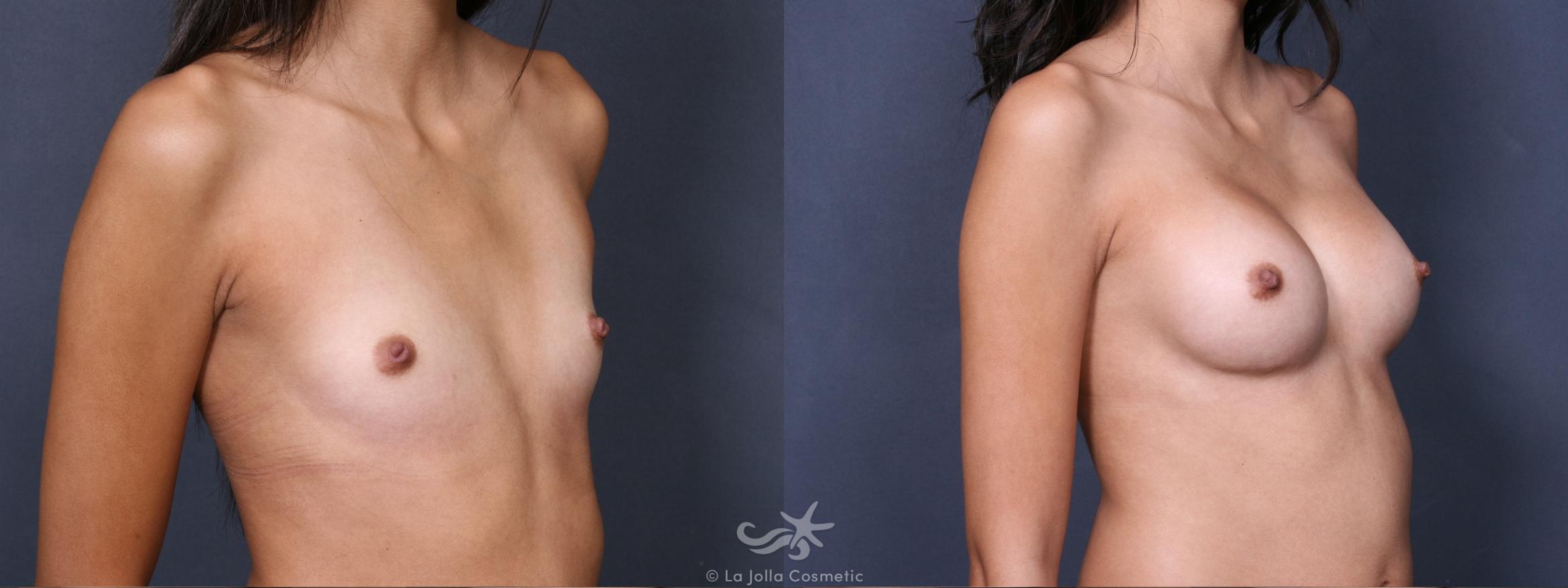 Before & After Breast Augmentation Result 379 Right Oblique View in San Diego, CA