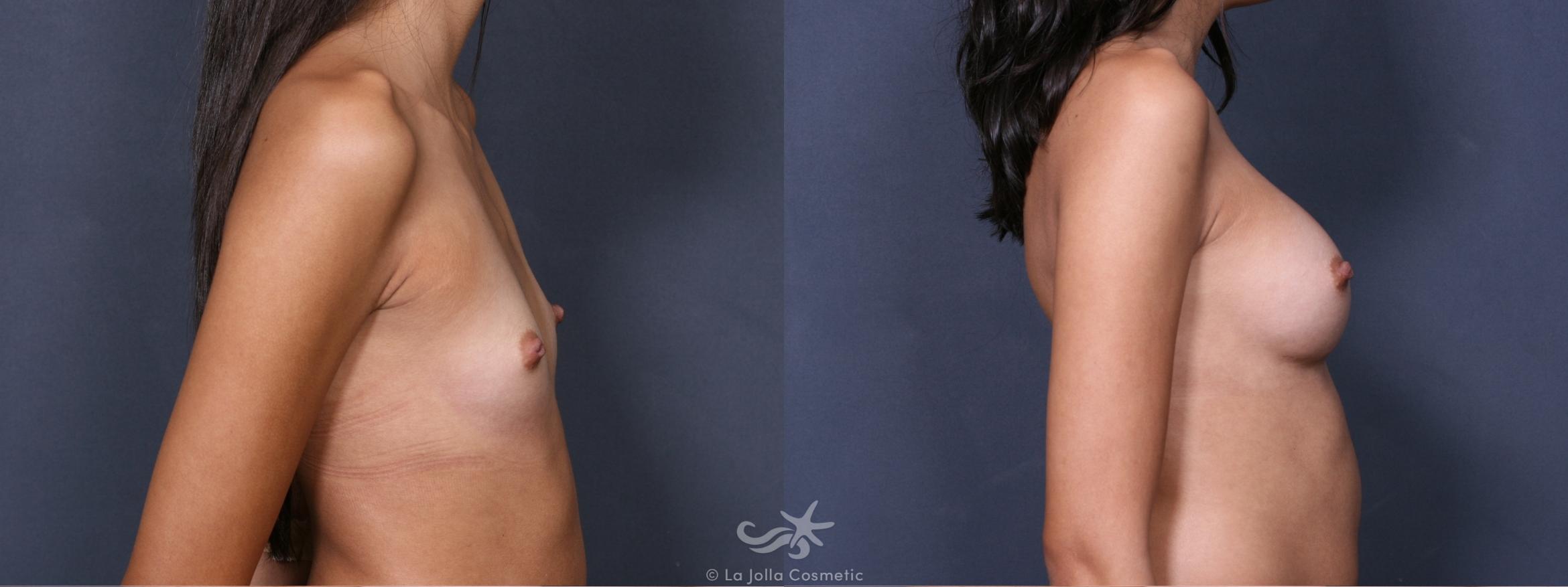 Before & After Breast Augmentation Result 379 Right Side View in San Diego, CA