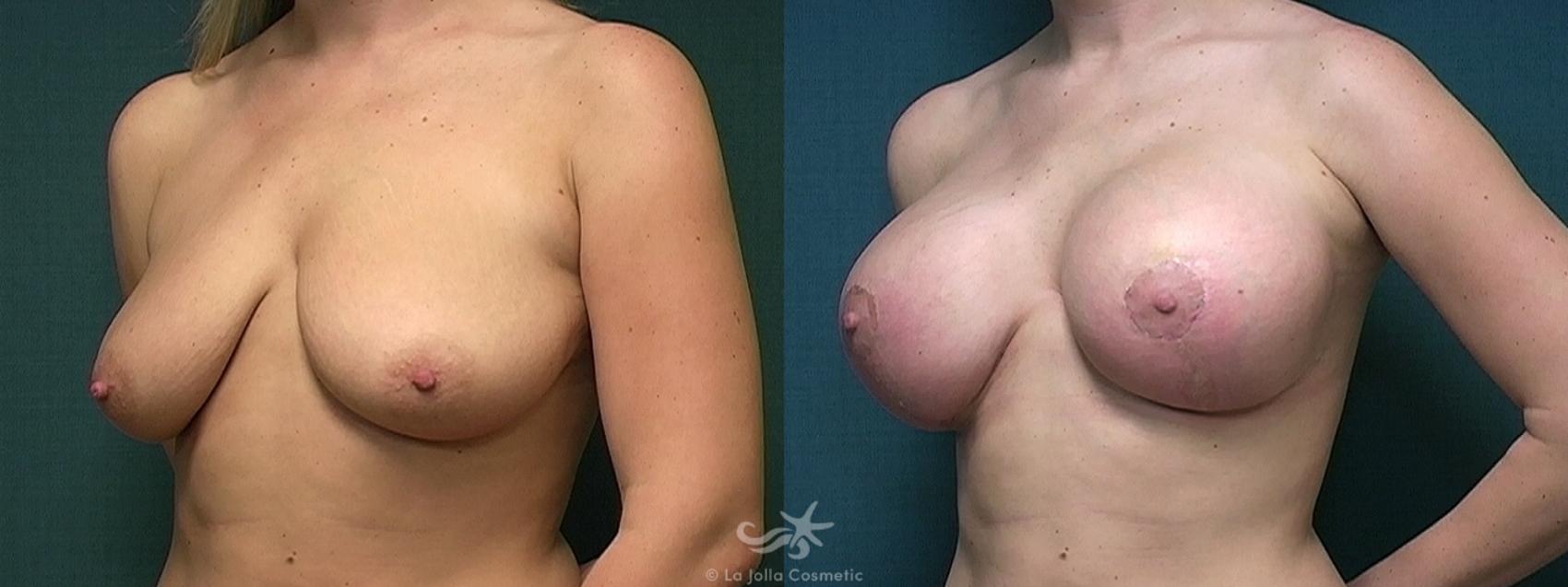 Before & After Breast Augmentation Result 383 Left Oblique View in San Diego, CA