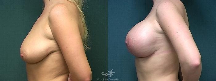 Before & After Breast Augmentation Result 383 Left Side View in San Diego, Carlsbad, CA