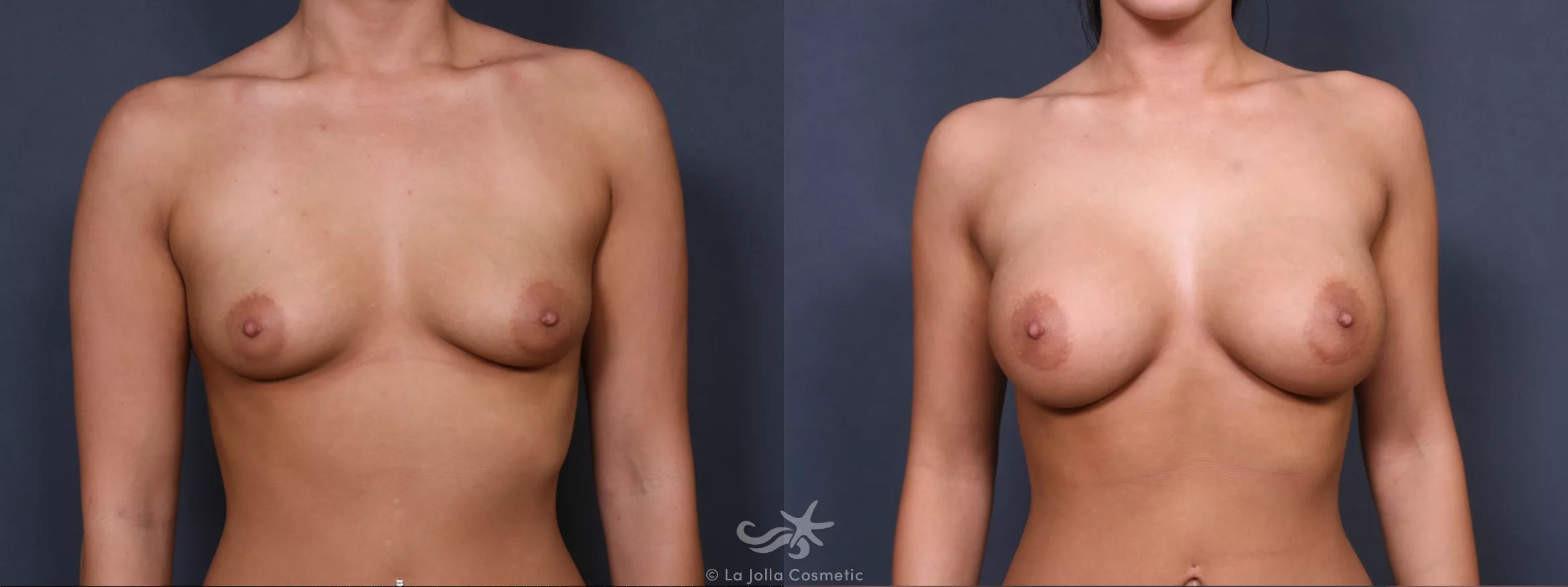 Before & After Breast Augmentation Result 385 Front View in San Diego, CA