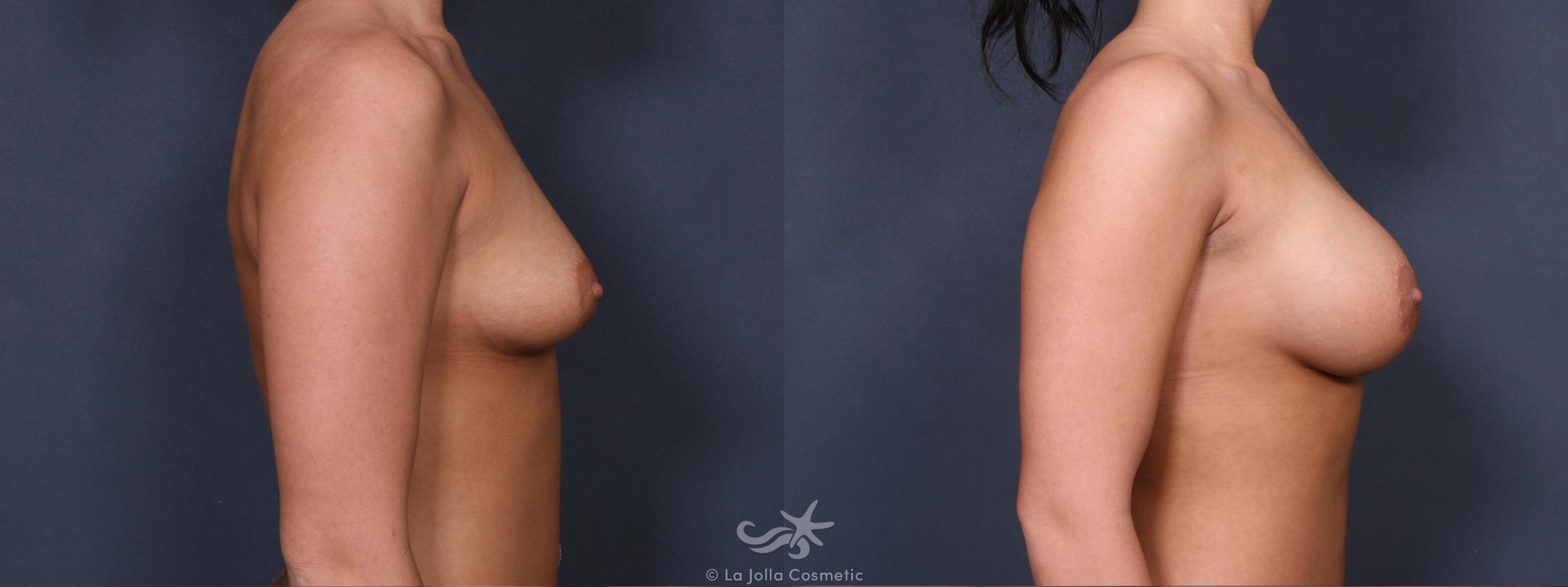 Before & After Breast Augmentation Result 385 Right Side View in San Diego, CA