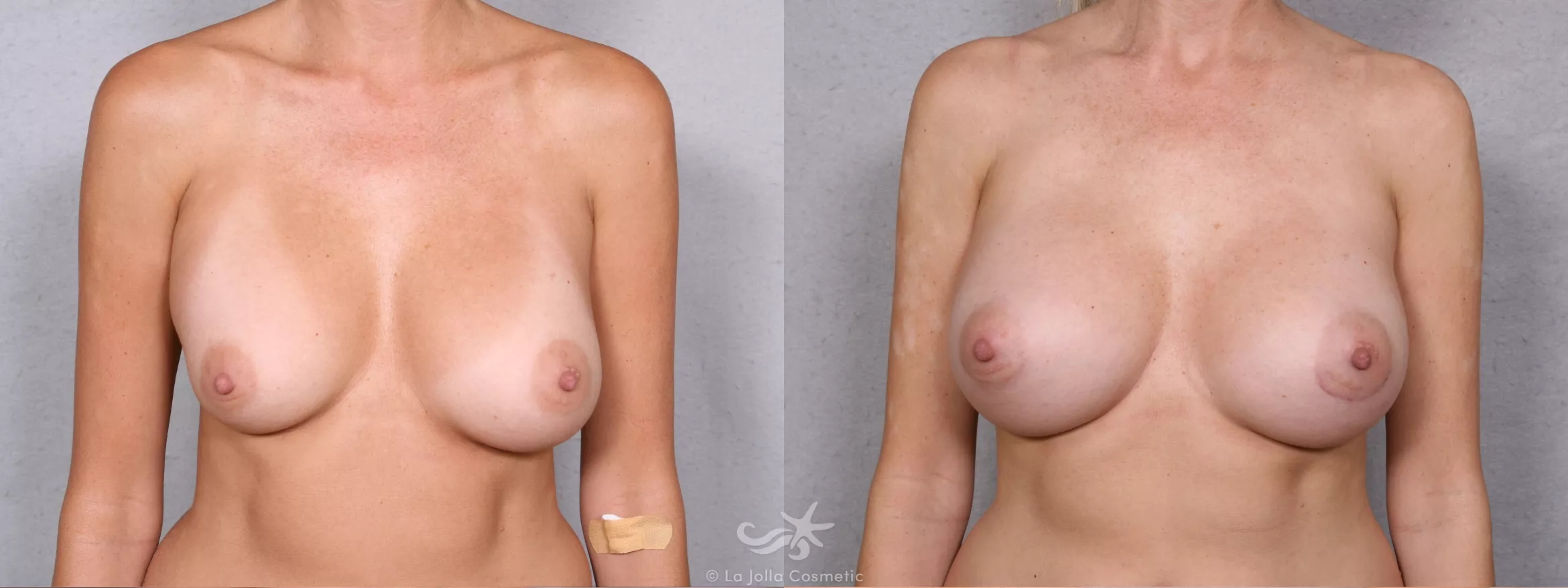 Before & After Breast Augmentation Result 386 Front View in San Diego, CA
