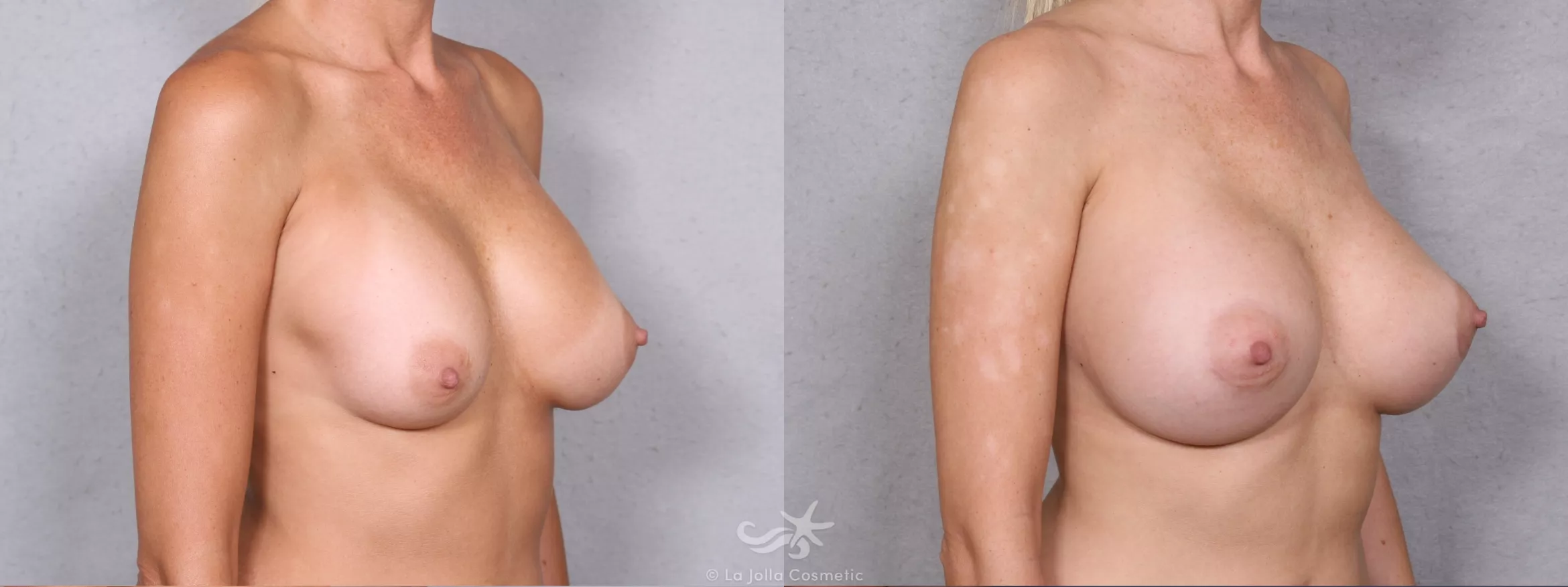Before & After Breast Augmentation Result 386 Right Oblique View in San Diego, CA