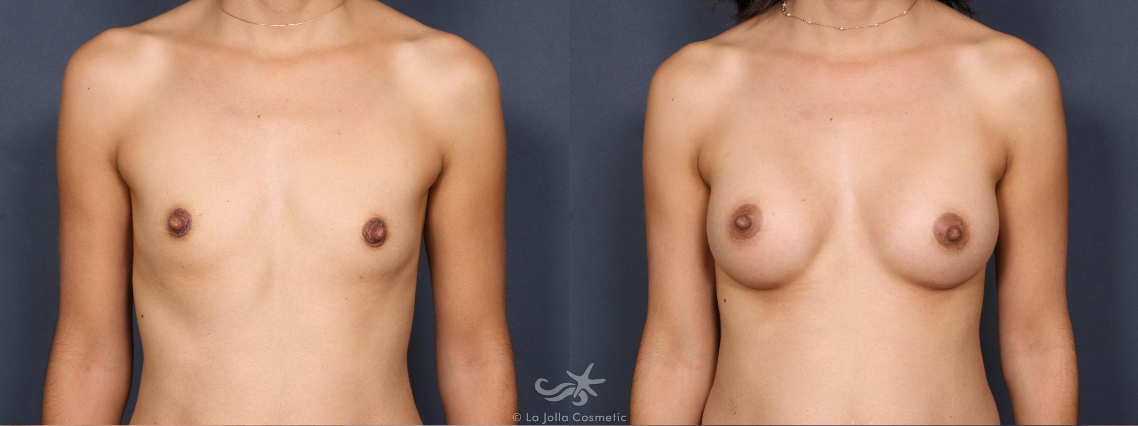 Before & After Breast Augmentation Result 387 Front View in San Diego, CA