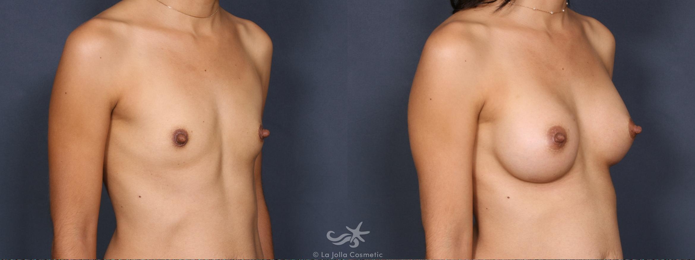 Before & After Breast Augmentation Result 387 Right Oblique View in San Diego, CA