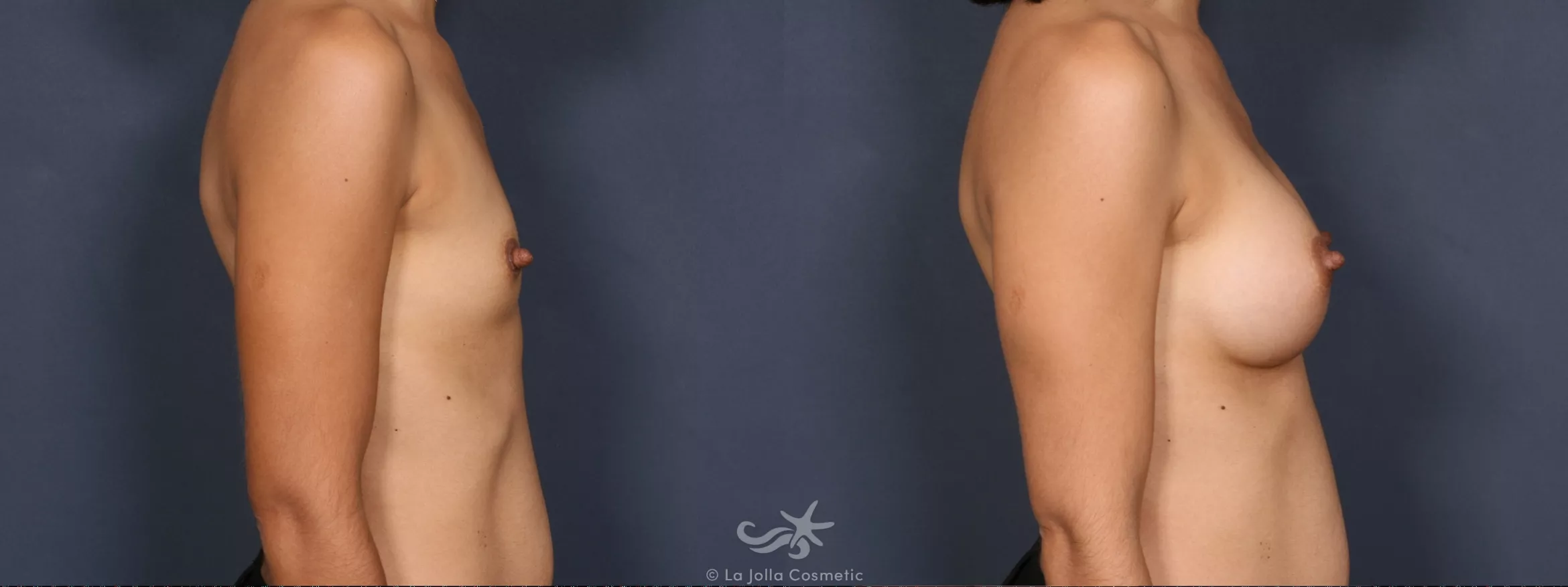 Before & After Breast Augmentation Result 387 Right Side View in San Diego, CA
