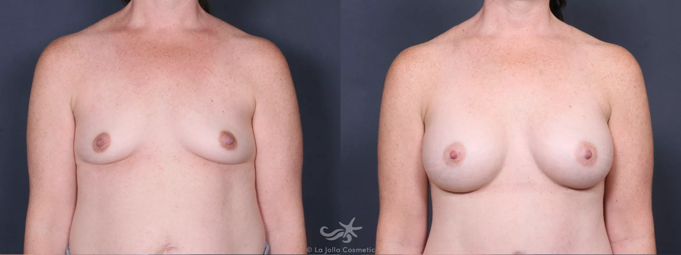 Before & After Breast Augmentation Result 389 Front View in San Diego, CA