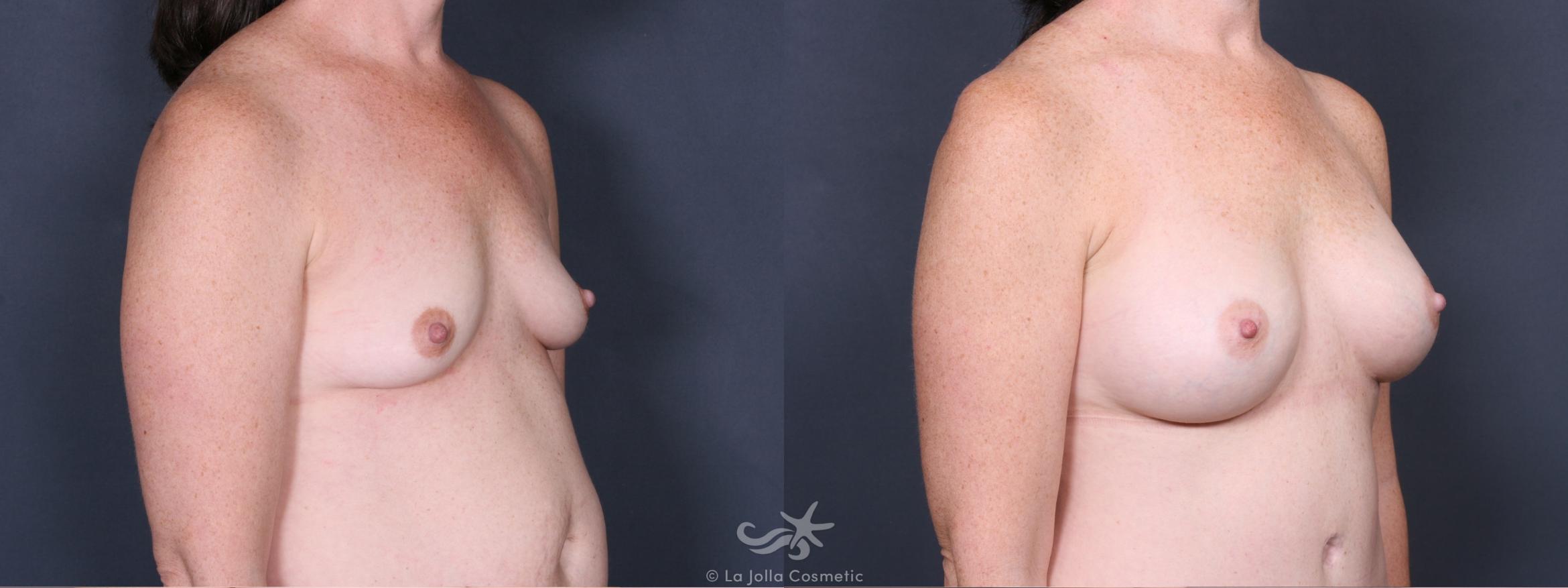 Before & After Breast Augmentation Result 389 Right Oblique View in San Diego, CA