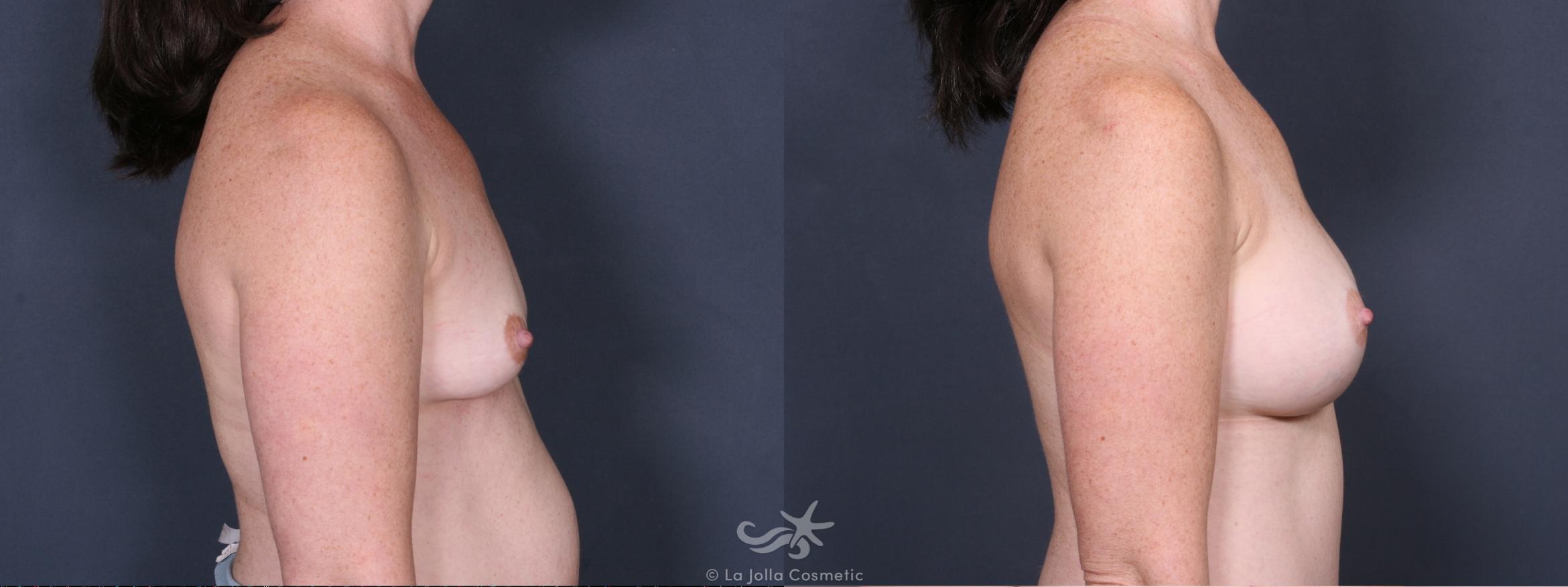Before & After Breast Augmentation Result 389 Right Side View in San Diego, CA