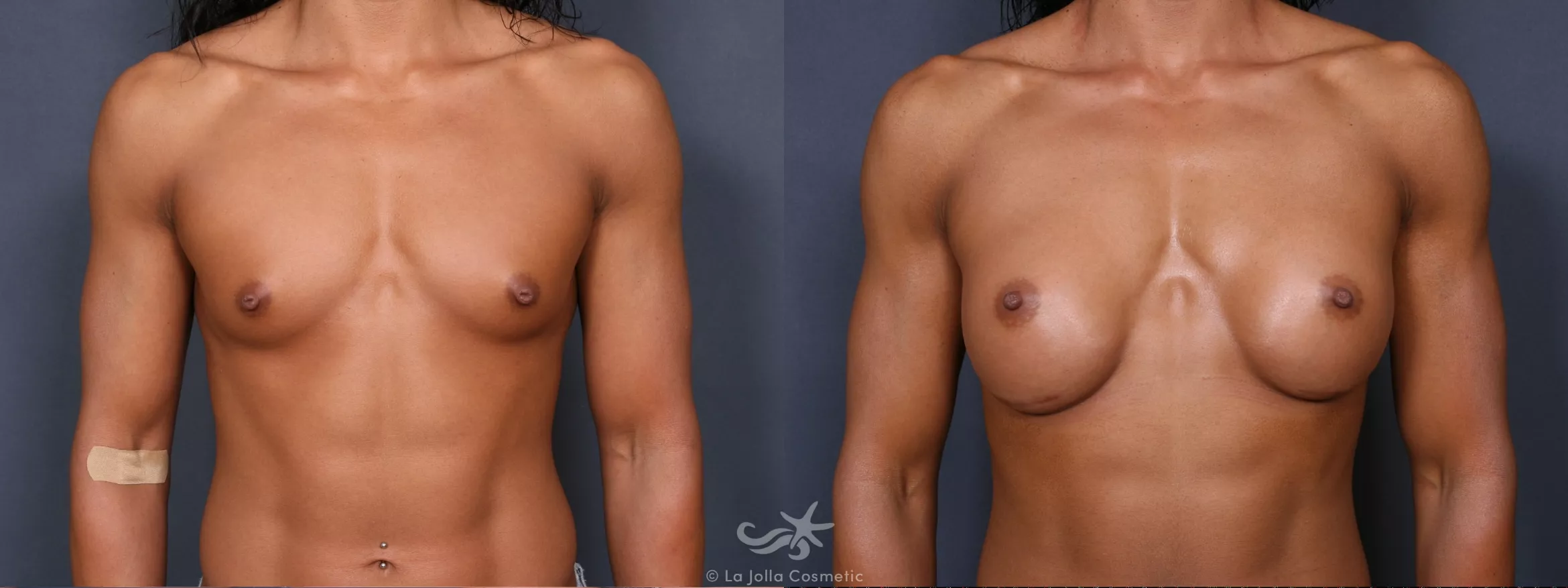 Before & After Breast Augmentation Result 392 Front View in San Diego, CA