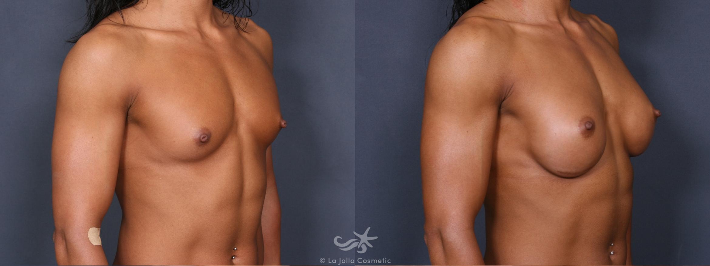 Before & After Breast Augmentation Result 392 Right Oblique View in San Diego, CA