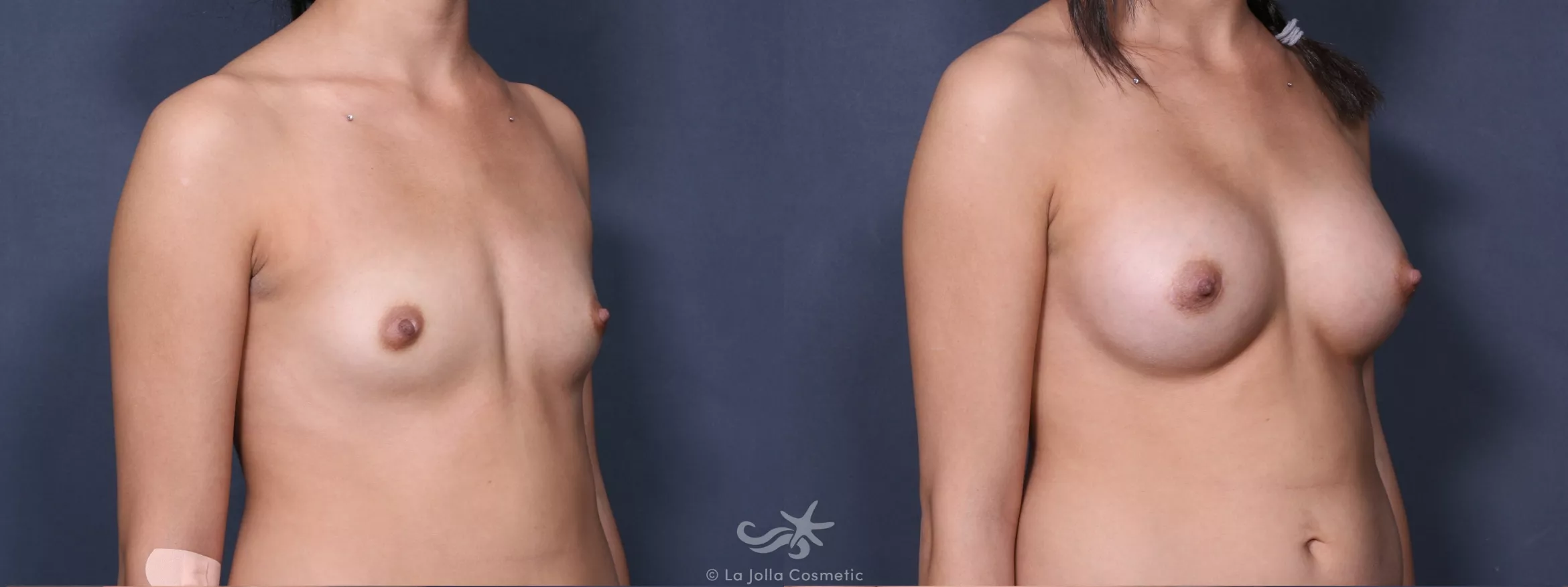 Before & After Breast Augmentation Result 393 Right Oblique View in San Diego, CA