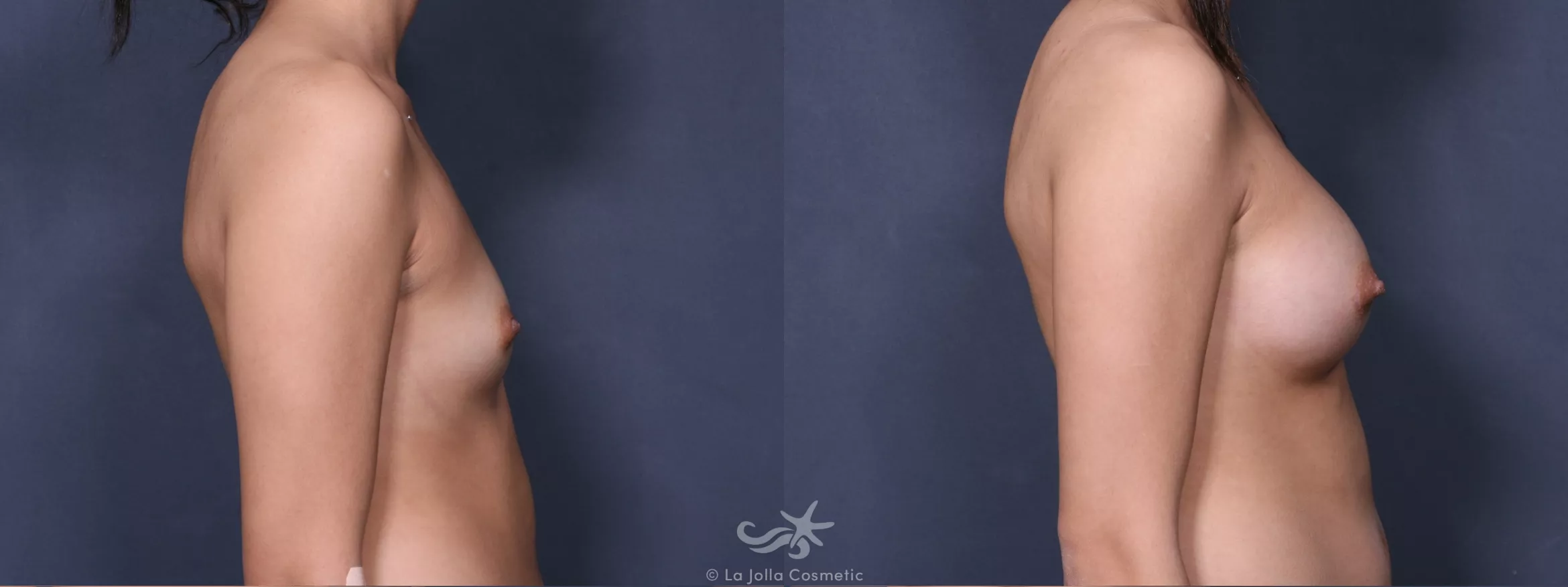 Before & After Breast Augmentation Result 393 Right Side View in San Diego, CA