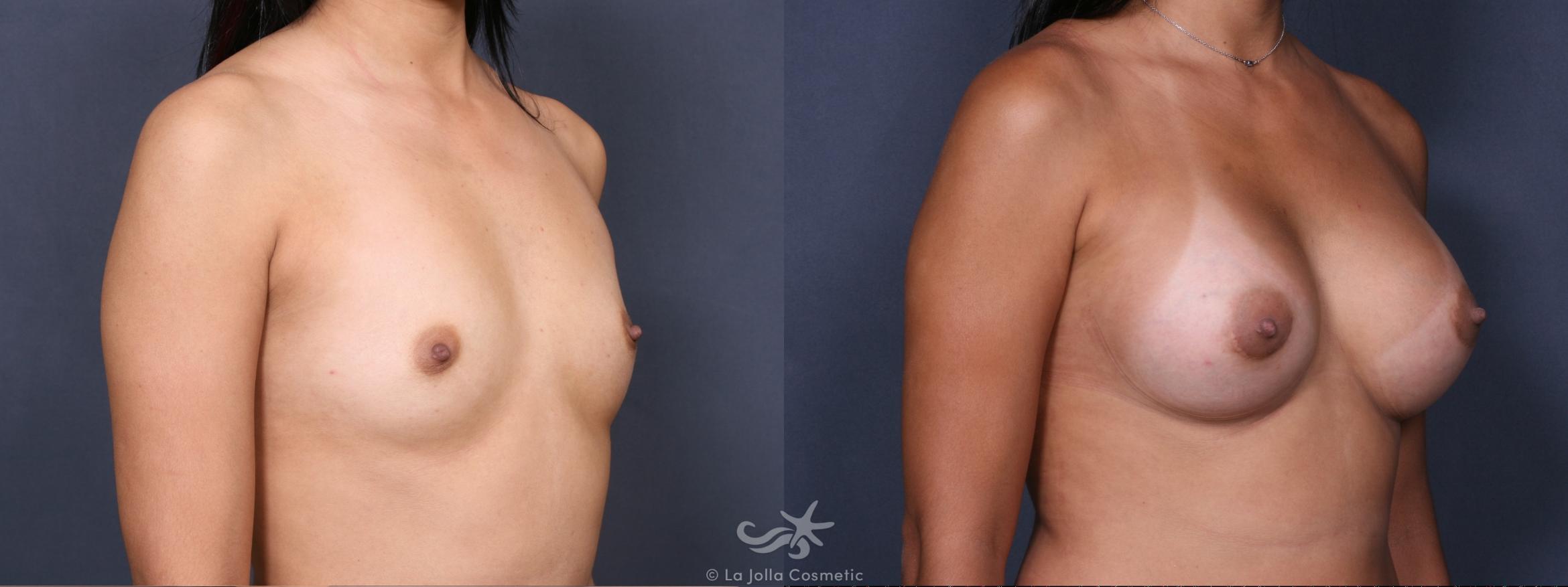 Before & After Breast Augmentation Result 394 Right Oblique View in San Diego, CA